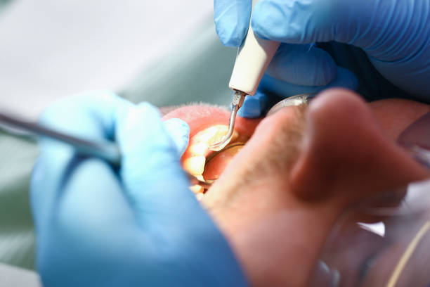 Best Emergency Dental Extractions in Snyderville, UT